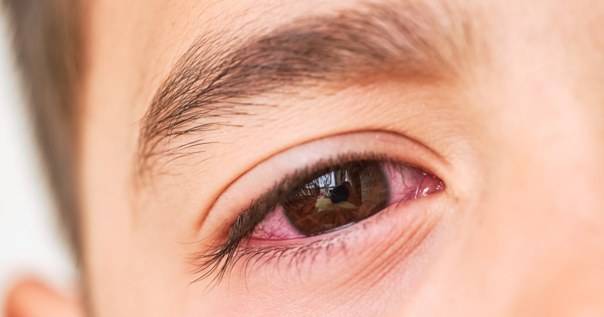 Most kids get antibiotics for pink eye. Experts say they’re not needed.