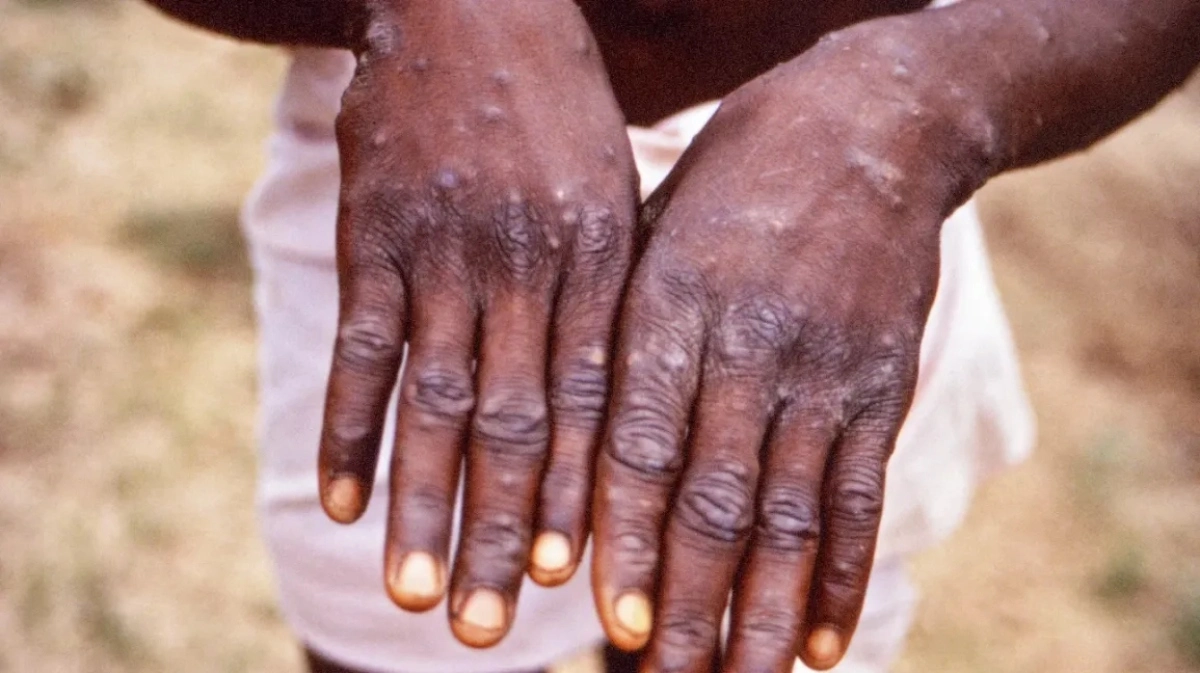 Zimbabwe Government Targets Borders To Combat MPox Public Health Emergency